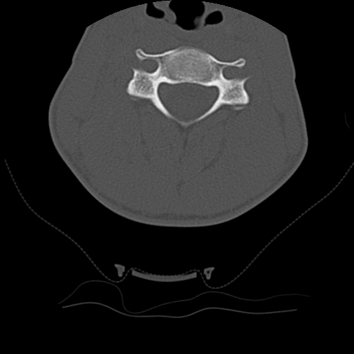 Normal trauma spine imaging (age 16) (Radiopaedia 45335-49358 Axial bone window 36).jpg