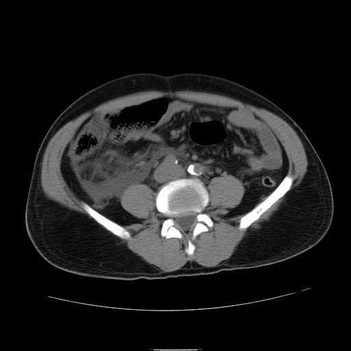File:Obstructed kidney with perinephric urinoma (Radiopaedia 26889-27066 Axial non-contrast 39).jpg
