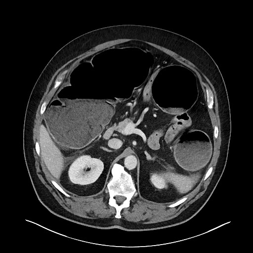 Obstructing sigmoid adenocarcinoma (Radiopaedia 58465-65619 A 53).jpg