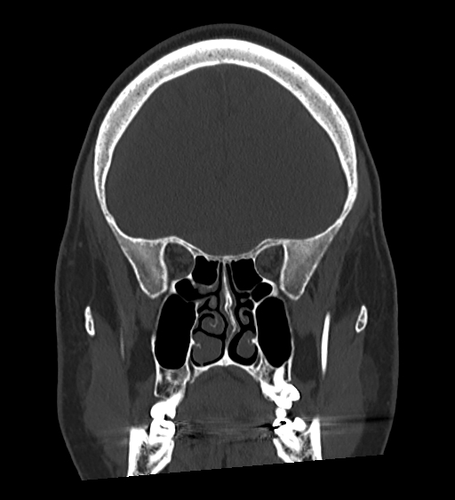 Occipital spur and Currarino type A atlas anomaly (Radiopaedia 87027-103285 Coronal bone window 56).jpg