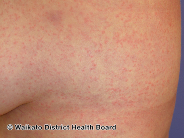 File:Zika virus infection (DermNet NZ viral-zika-3).jpg