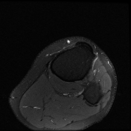 File:ACL and meniscal tears (Radiopaedia 79604-92797 Axial PD fat sat 25).jpg