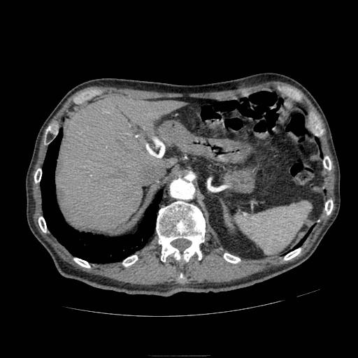 Abdominal aortic aneurysm (Radiopaedia 13341-13340 Axial C+ arterial phase 36).jpg