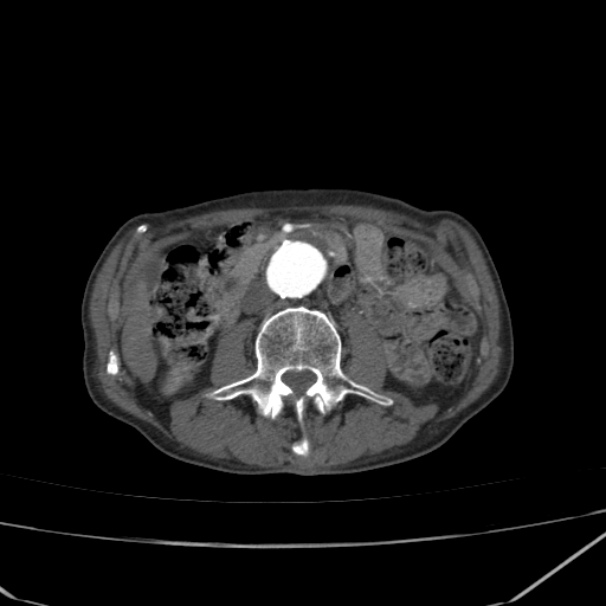 Abdominal aortic aneurysm (Radiopaedia 23703-23856 Axial C+ arterial phase 39).jpg