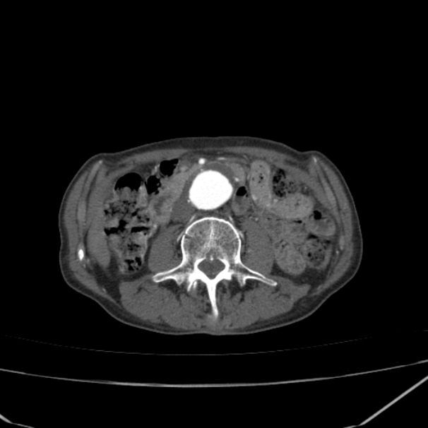 Abdominal aortic aneurysm (Radiopaedia 23703-23856 Axial C+ arterial phase 40).jpg