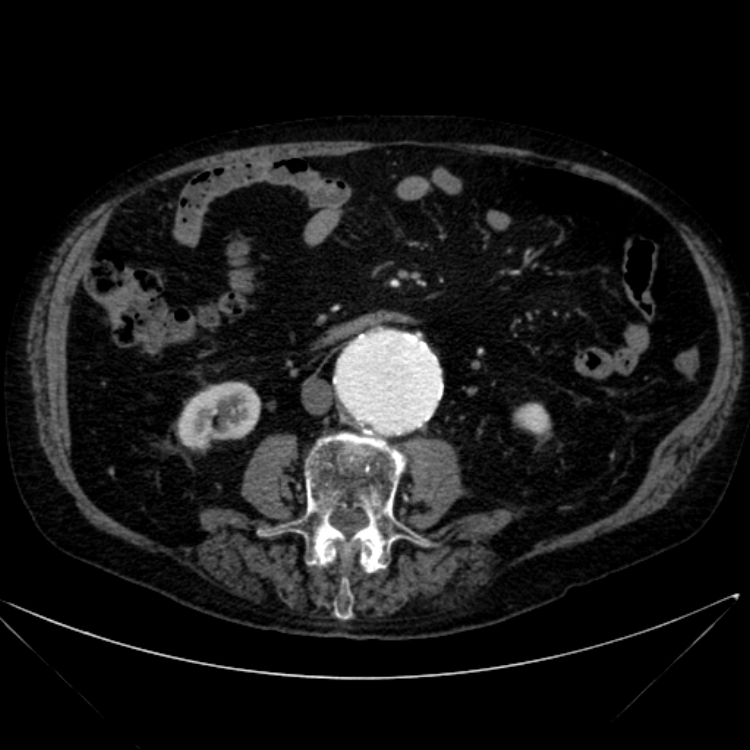 Abdominal aortic aneurysm (Radiopaedia 25855-26001 Axial C+ arterial phase 69).jpg