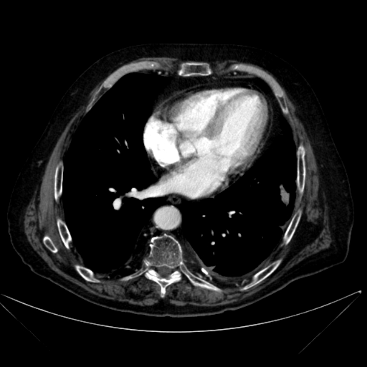 Abdominal aortic aneurysm (Radiopaedia 25855-26001 Axial C+ arterial phase 7).jpg