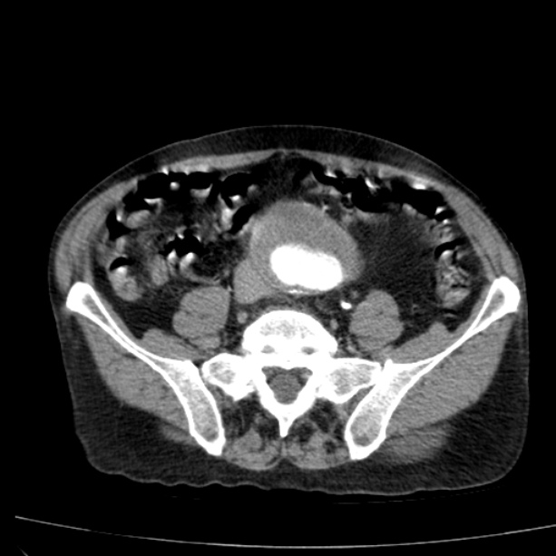 Abdominal aortic aneurysm (Radiopaedia 29248-29660 Axial C+ arterial phase 60).jpg