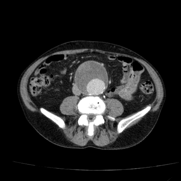 Abdominal aortic aneurysm (Radiopaedia 29248-29660 Axial C+ portal venous phase 37).jpg