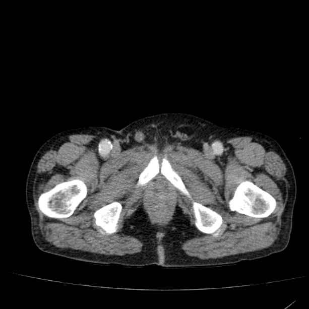 Abdominal aortic aneurysm (Radiopaedia 29248-29660 Axial C+ portal venous phase 66).jpg