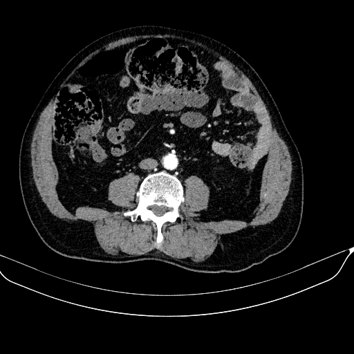 Abdominal aortic aneurysm (Radiopaedia 67117-76452 Axial C+ arterial phase 77).jpg