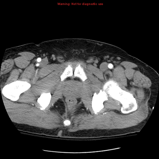 Abdominal aortic aneurysm (Radiopaedia 8190-9038 Axial C+ arterial phase 85).jpg