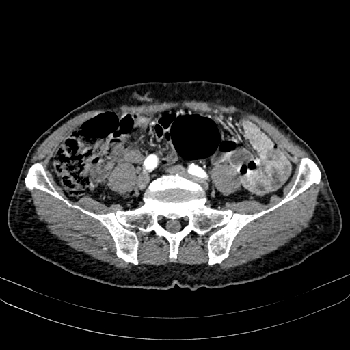 Abdominal aortic aneurysm (Radiopaedia 83581-98689 Axial C+ arterial phase 82).jpg