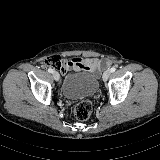 Abdominal aortic aneurysm (Radiopaedia 83581-98689 Axial C+ portal venous phase 98).jpg