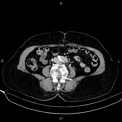 Abdominal aortic aneurysm (Radiopaedia 85063-100606 Axial C+ delayed 77).jpg