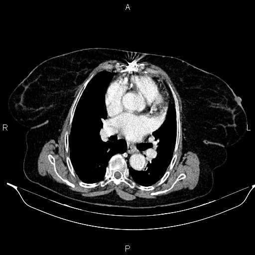 File:Abdominal aortic aneurysm (Radiopaedia 85063-100606 Axial C+ portal venous phase 18).jpg