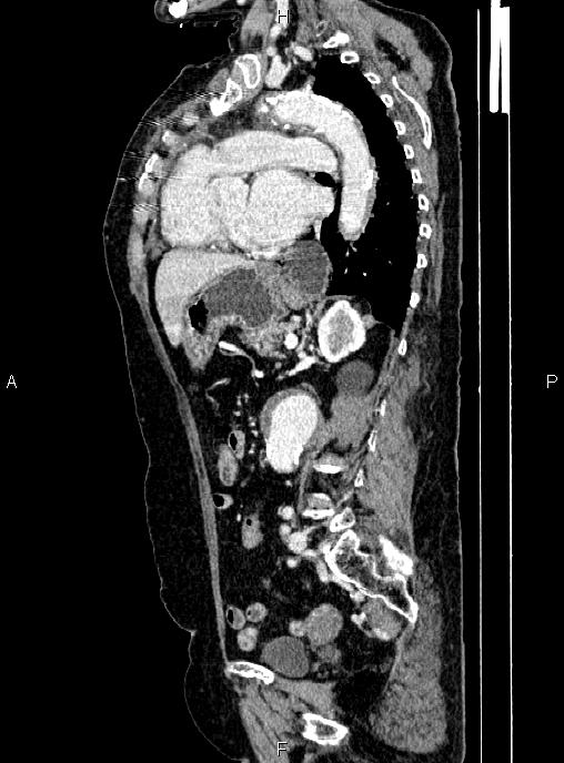 Abdominal aortic aneurysm (Radiopaedia 85063-100606 Sagittal C+ arterial phase 51).jpg