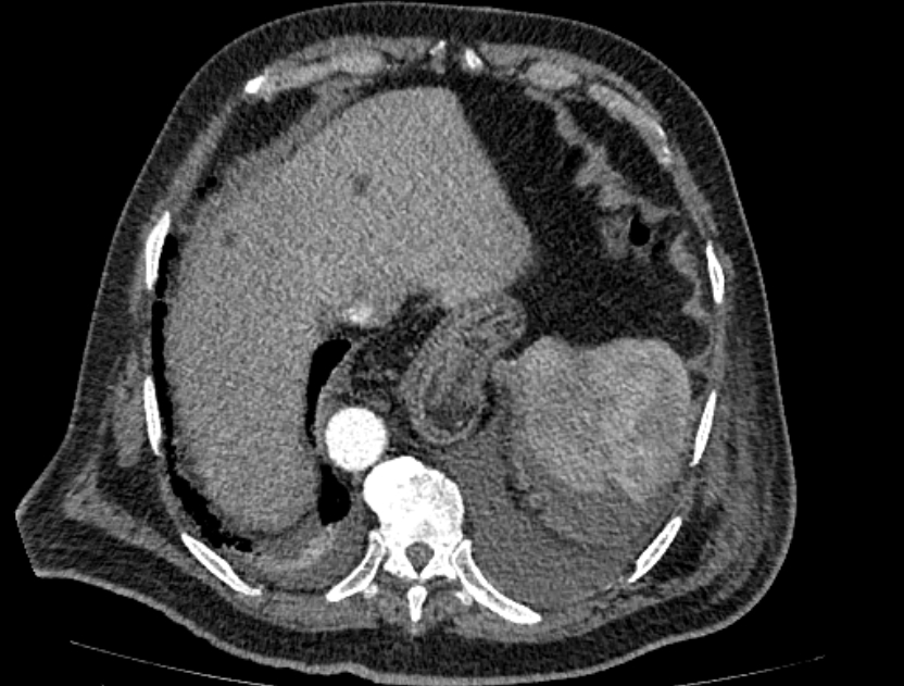 Abdominal aortic aneurysm rupture (Radiopaedia 54179-60362 Axial C+ arterial phase 19).jpg