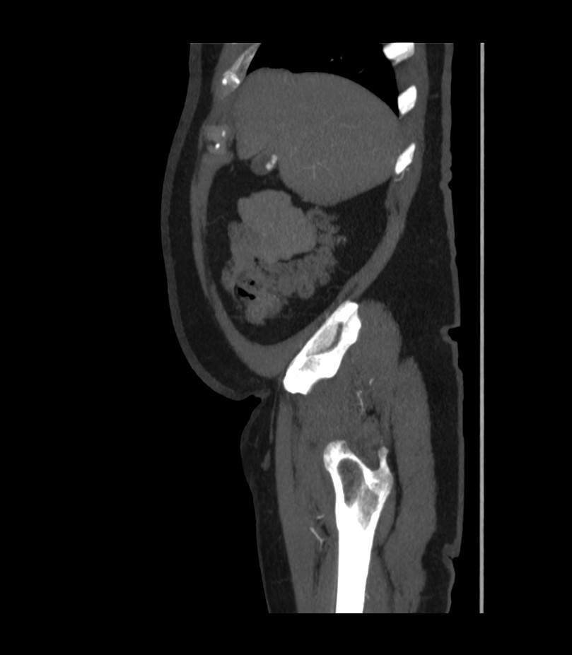 Abdominal aortic aneurysm with thrombus fissuration (Radiopaedia 46218-50618 Sagittal C+ arterial phase 8).jpg