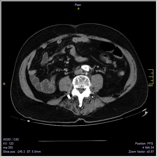 Abdominal aortic aneurysm with thrombus fissuration (Radiopaedia 47340-51926 Axial C+ arterial phase 38).jpg