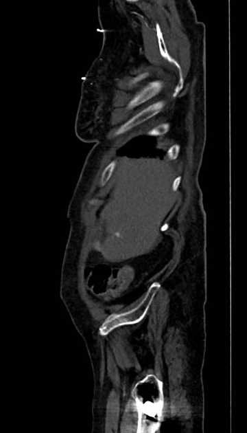 Abdominal aortic aneurysm with thrombus fissuration (Radiopaedia 73192-83919 Sagittal C+ arterial phase 129).jpg