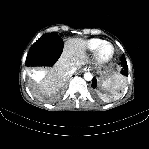 File:Abdominal collection due to previous cecal perforation (Radiopaedia 80831-94320 Axial C+ portal venous phase 24).jpg