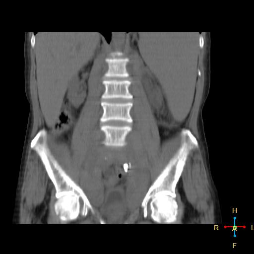 File:Abdominal lymphoma (Radiopaedia 23085-23115 Coronal non-contrast 11).jpg