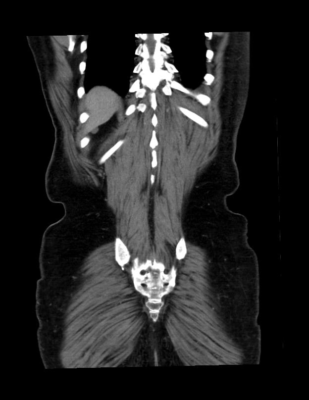 Abdominal lymphoma - with sandwich sign (Radiopaedia 53486-59492 C+ portal venous phase 6).jpg