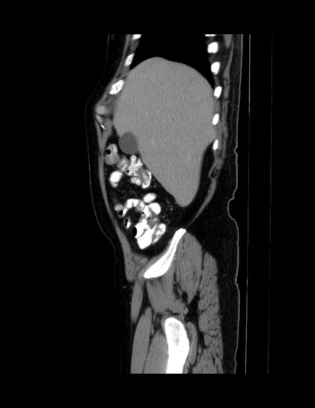 Abdominal lymphoma - with sandwich sign (Radiopaedia 53486-59492 Sagittal C+ portal venous phase 67).jpg