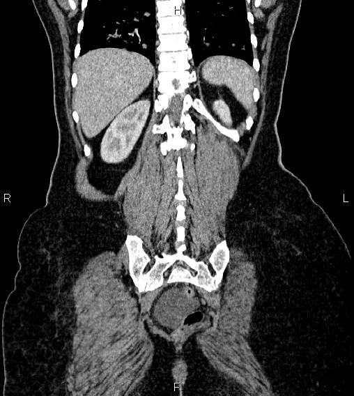 Abdominal lymphoma with sandwich sign (Radiopaedia 84378-99704 Coronal C+ portal venous phase 57).jpg