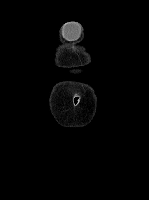 Abdominal wall and retroperitoneal tuberculosis (Radiopaedia 88137-104729 Coronal C+ portal venous phase 4).jpg