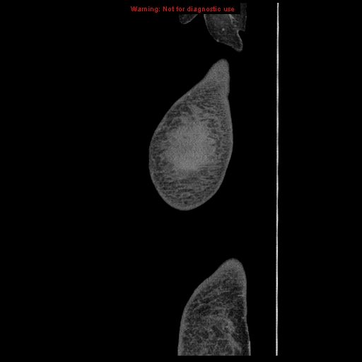 Abdominal wall hematoma (Radiopaedia 9427-10112 Sagittal C+ portal venous phase 113).jpg