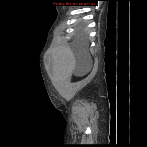 Abdominal wall hematoma (Radiopaedia 9427-10112 Sagittal C+ portal venous phase 98).jpg