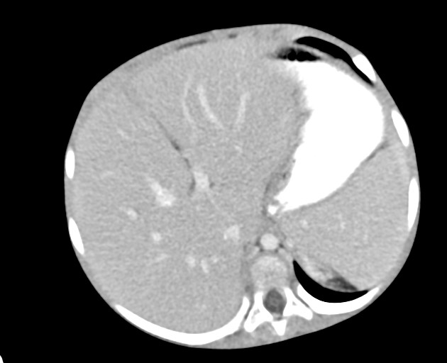 Abdominopelvic rhabdomyosarcoma (Radiopaedia 78356-90984 Axial C+ portal venous phase 50).jpg