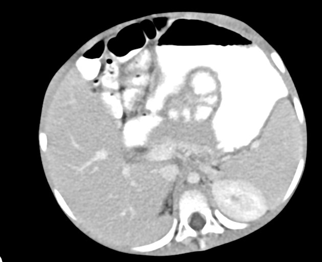 File:Abdominopelvic rhabdomyosarcoma (Radiopaedia 78356-90984 Axial C+ portal venous phase 58).jpg