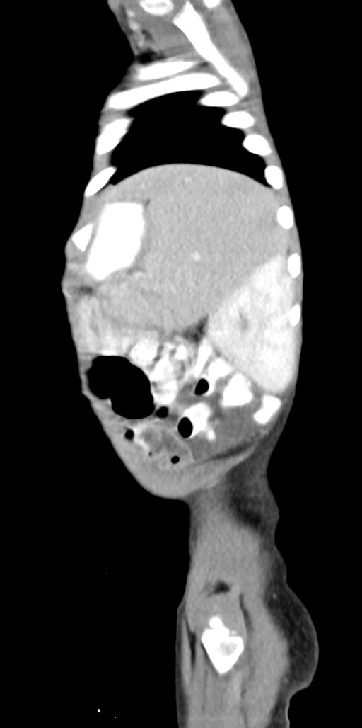 Abdominopelvic rhabdomyosarcoma (Radiopaedia 78356-90984 Sagittal C+ portal venous phase 16).jpg