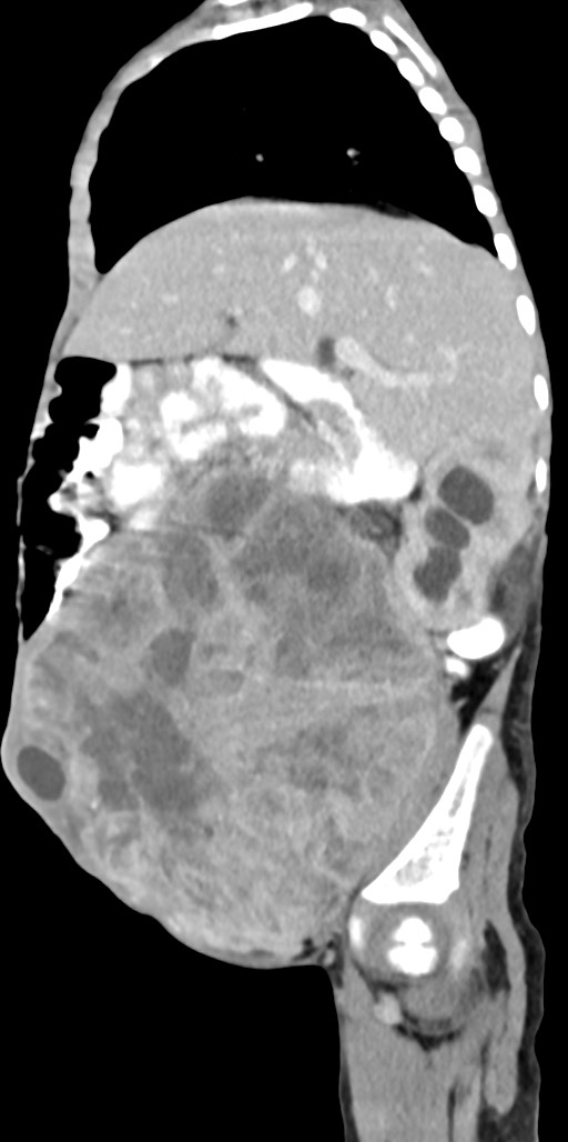 Abdominopelvic rhabdomyosarcoma (Radiopaedia 78356-90984 Sagittal C+ portal venous phase 66).jpg