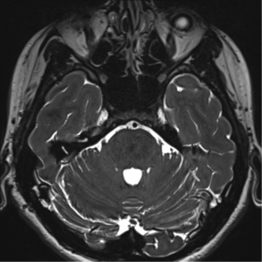 File:Abducens nerve palsy (Radiopaedia 51069-56648 Axial T2 fat sat 34).png