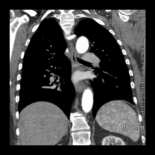 File:Aberrant right subclavian artery stenosis (Radiopaedia 52656-58670 B 56).jpg