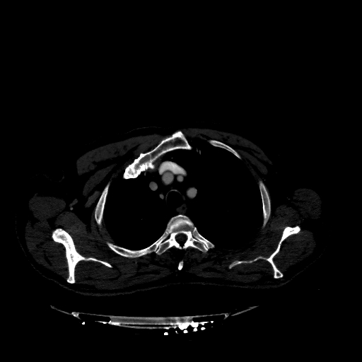 Accesory rib joint (Radiopaedia 71987-82452 Axial bone window 76).jpg
