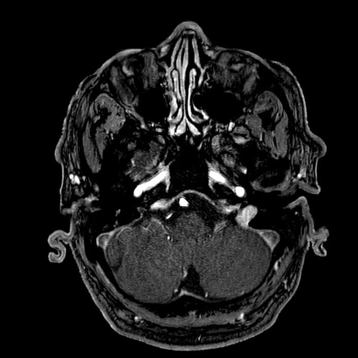 Accessory middle cerebral artery (Radiopaedia 73114-83828 Axial MRA 24).jpg