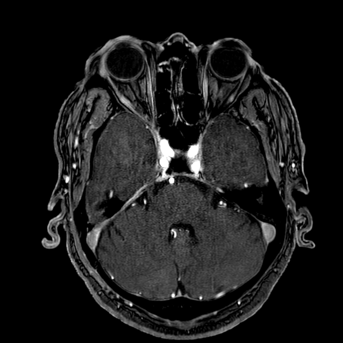 Accessory middle cerebral artery (Radiopaedia 73114-83828 Axial MRA 46).jpg