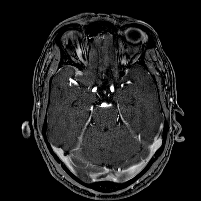 Accessory middle cerebral artery (Radiopaedia 73114-83828 Axial MRA 64).jpg