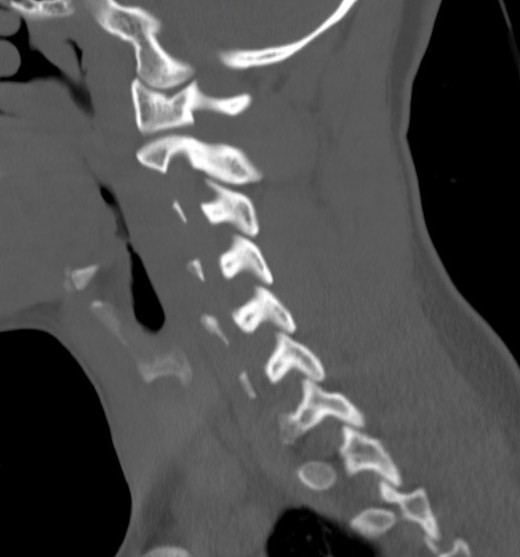 File:Accessory ossicle of the anterior arch of C1 vertebra (Radiopaedia 58149-65211 Sagittal bone window 4).jpg