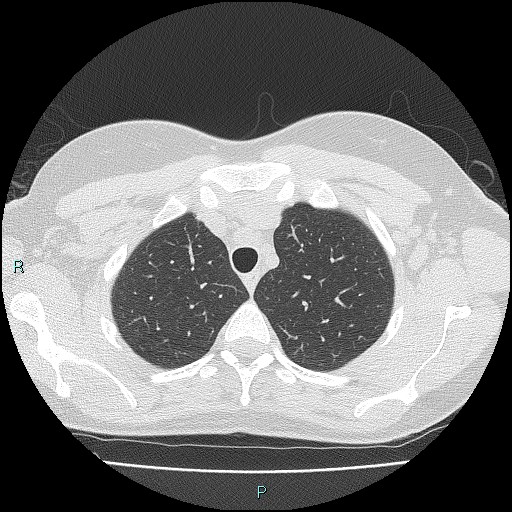 Accidental foreign body aspiration (seamstress needle) (Radiopaedia 77740-89983 Axial lung window 13).jpg