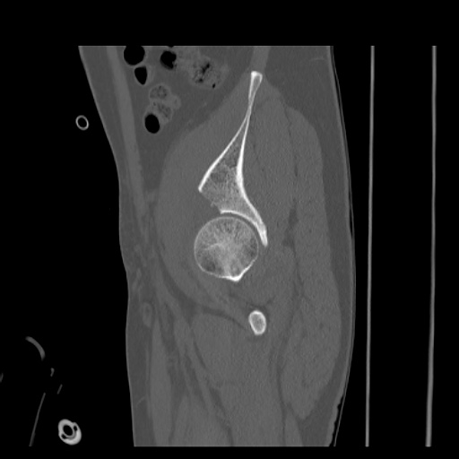 Acetabular and ilial fractures (Radiopaedia 59084-66378 Sagittal bone window 23).jpg