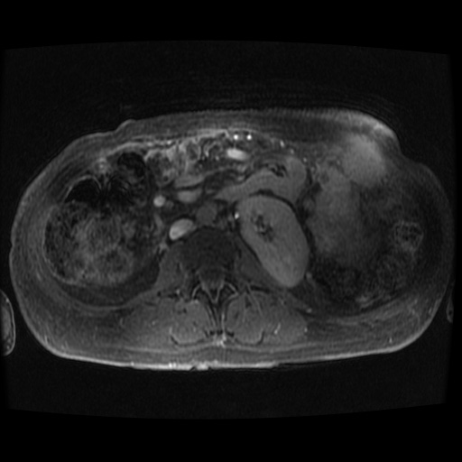 Acinar cell carcinoma of the pancreas (Radiopaedia 75442-86668 Axial late phase (~30 mins) 13).jpg
