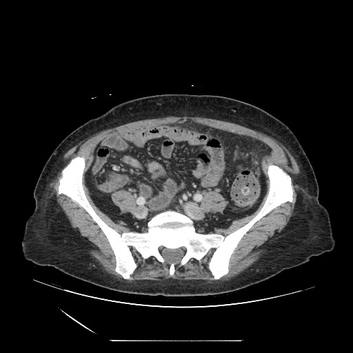 Acinar cell carcinoma of the pancreas (Radiopaedia 75442-86669 Axial C+ portal venous phase 105).jpg