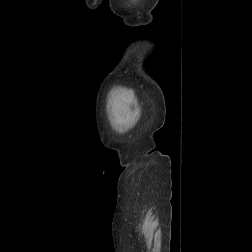 File:Acinar cell carcinoma of the pancreas (Radiopaedia 75442-86669 Sagittal C+ portal venous phase 20).jpg