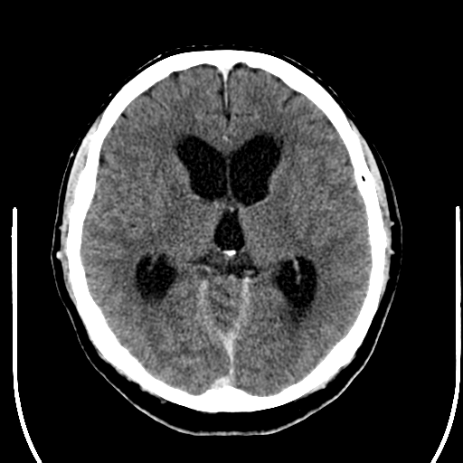 File:Acoustic schwannoma (Radiopaedia 39170-41389 Axial C+ 14).png